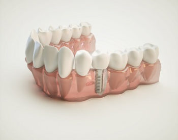 Dental Implants