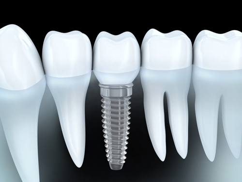 What is Bone Grafting?